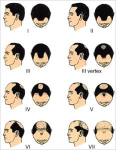 Norwood Scale of Male Pattern Baldness