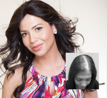 womens hair loss replacement restoration richmond va