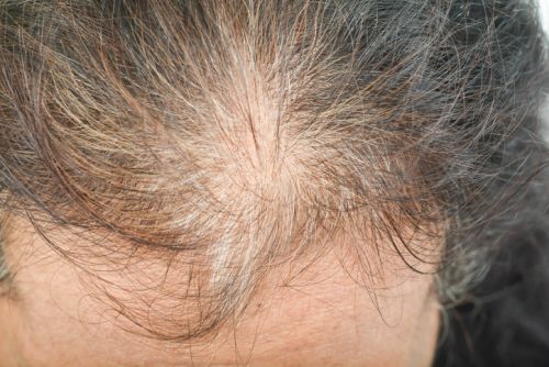 alopecia no cicatricial